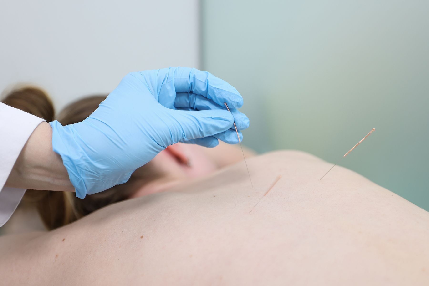 Акупунктура